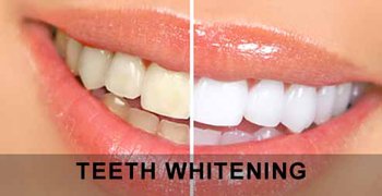 Before and after Teeth Whitening Cosmetic Dentistry.