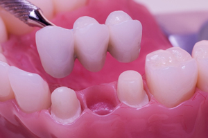 Crown and Bridges Dental Surgery