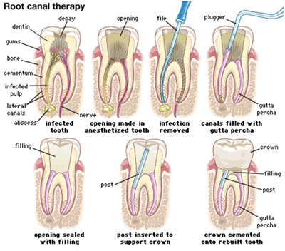 Root Canal Oral Surgery